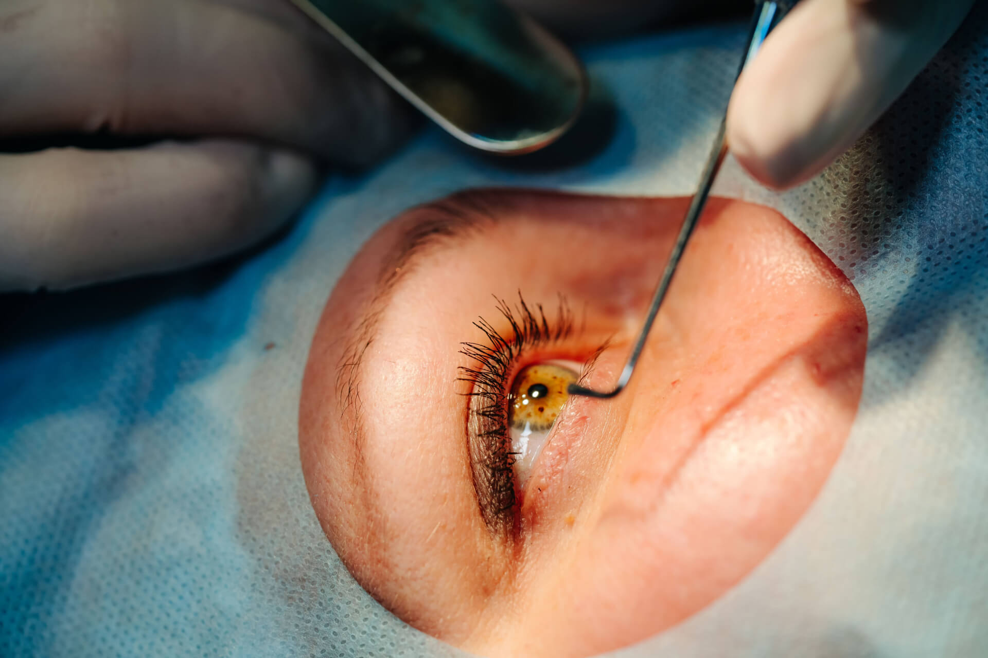 eye surgery LASIK